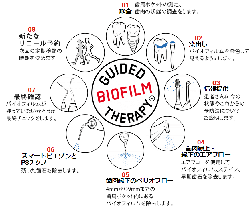 GBT(Guided Biofilm Therapy)vgR[̂W̃Xebv