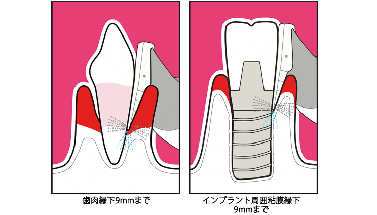 ペリオフローによる歯周ポケットの清掃