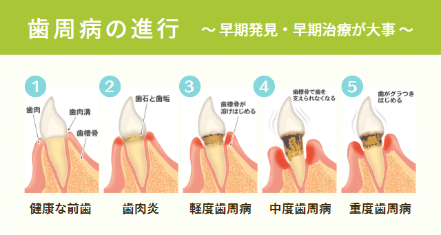 歯周病の進行