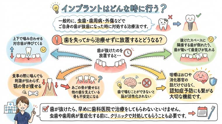 インプラントとはどんな治療？｜クローバー歯科豊中駅前院 よくあるご質問