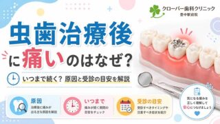 虫歯治療後に痛いのはなぜ？いつまで続く？原因と受診の目安を解説
