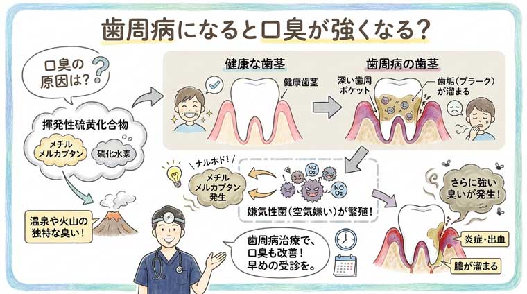 お口の嫌な臭いは揮発性硫黄化合物(メチルメルカプタンや硫化水素)によるものです。
硫化水素は、温泉や火山などで発生する独特な臭いです。歯周病になると歯周ポケットが深くなってその中に歯垢が溜まり、細菌がどんどん繁殖します。
歯周病菌の多くは空気のある環境を嫌う嫌気性菌で、代謝の過程でメチルメルカプタンや硫化水素といった、臭いの元になる物質を出します。
また、歯茎に炎症が起こり、出血したり膿が溜まったりすると、そこからも強い臭いが発生します。の図解