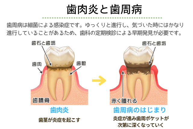 歯肉炎と歯周病