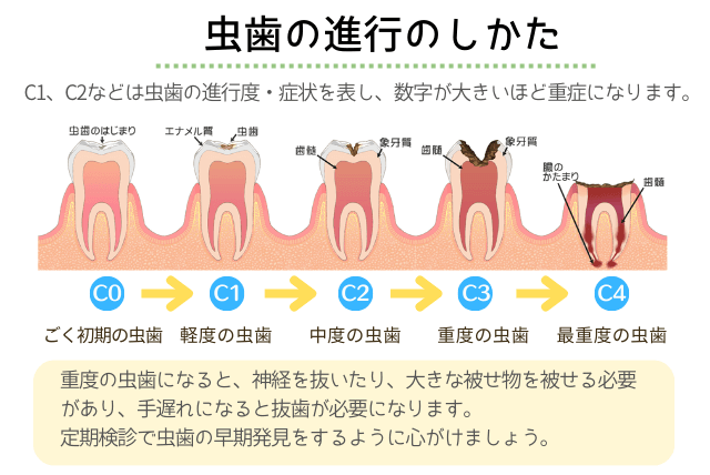 虫歯の進行のしかた