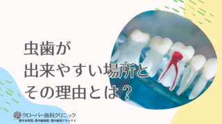 虫歯が出来やすい場所とその理由とは？