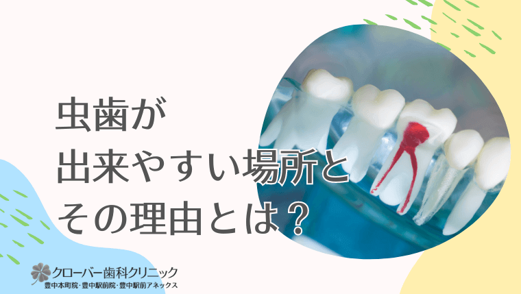 虫歯が出来やすい場所とその理由とは？