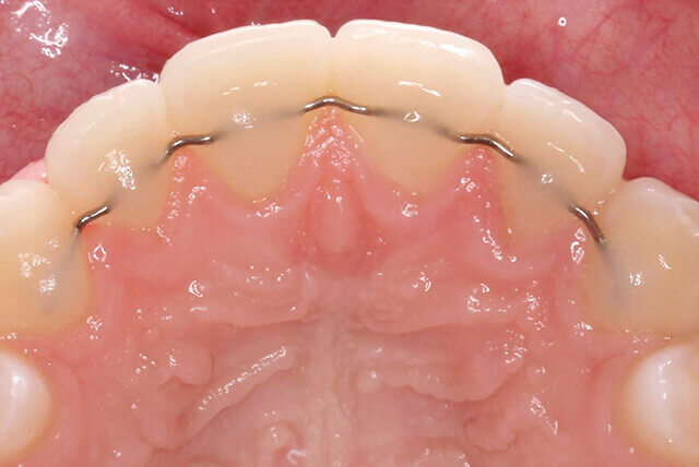 固定式リテーナー