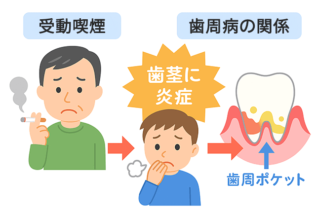 受動喫煙と歯周病