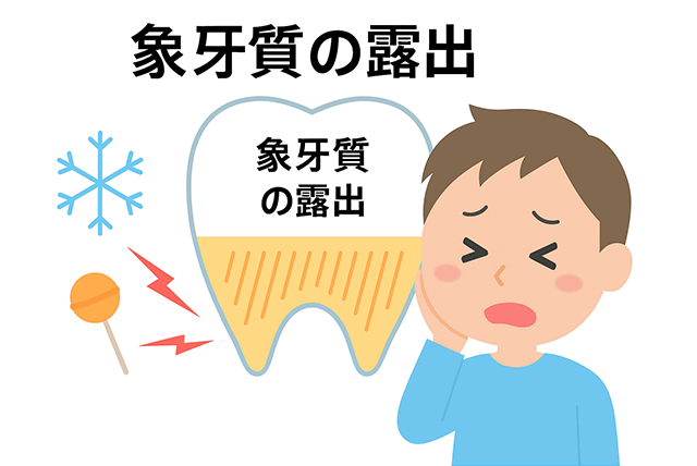 知覚過敏の原因は「象牙質の露出」から