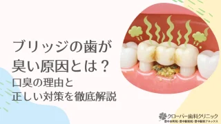 ブリッジの歯が臭い原因とは？口臭の理由と正しい対策を徹底解説