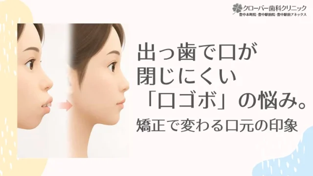 出っ歯で口が閉じにくい「口ゴボ」の悩み。矯正で変わる口元の印象