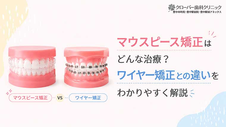 マウスピース矯正はどんな治療？ワイヤー矯正との違いをわかりやすく解説