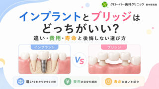 インプラントとブリッジはどっちがいい？違い・費用・寿命と後悔しない選び方