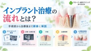 インプラント治療の流れとは？手術前から治療後まで順番に解説