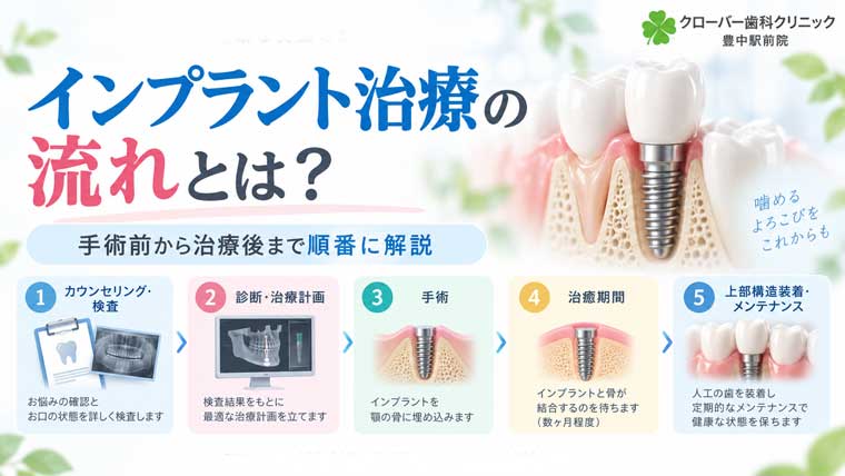インプラント治療の流れとは？手術前から治療後まで順番に解説