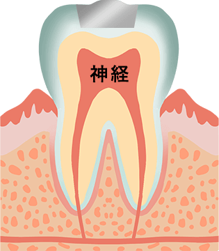 歯の詰め物と神経
