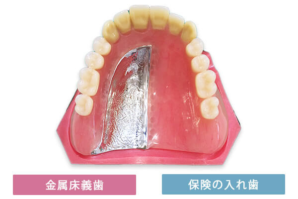 金属床義歯と保険の入れ歯