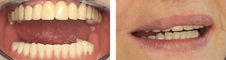 ロケーター義歯症例