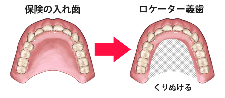 入れ歯 値段 総