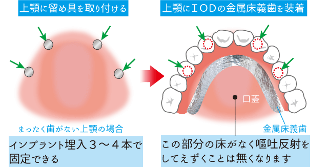 CvgI[o[f`[̏{̑ꎕ̏ꍇ