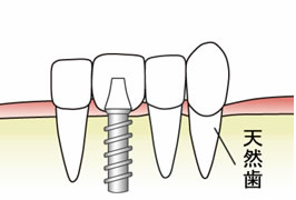1本の場合