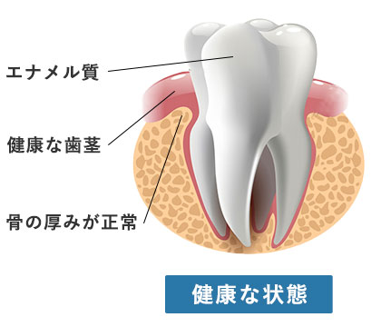 正常な歯と歯周病の比較
