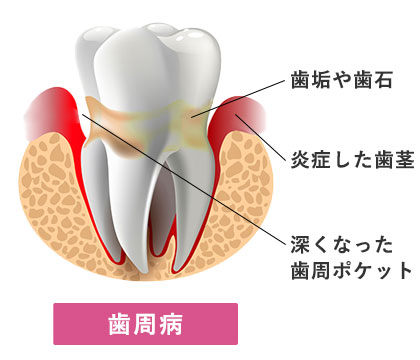 正常な歯と歯周病の比較