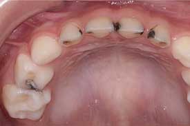 乳歯が虫歯
